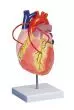 Cœur avec pontage coronarien grossi 2 fois G206 Erler Zimmer
