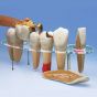Modèle de prothèse dentaire, en 7 parties W42529
