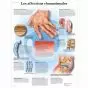 Planche anatomique Les affections rhumatismales VR2124L
