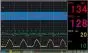 Cardiotocographe moniteur foetal One Medical Leto 8 Nova + VCT