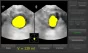 Bladder scanner / Scanner vésical Vitascan