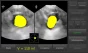 Bladder scanner / Scanner vésical Vitascan