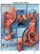 Planche anatomique Cancer du côlon VR2432UU