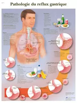 Planche anatomique Pathologie du reflux gastrique VR2711UU