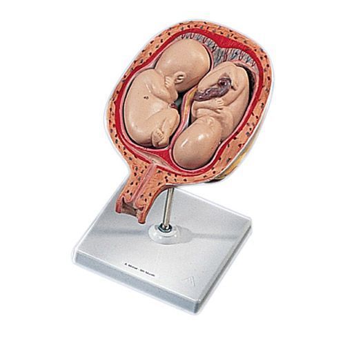 fœtus jumeaux a 5 mois position normale l10 7 a 127 78
