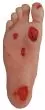 Modèle de pied diabétique avec ulcères R50067 Erler Zimmer