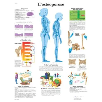 Planche anatomique L'ostéoporose VR2121UU