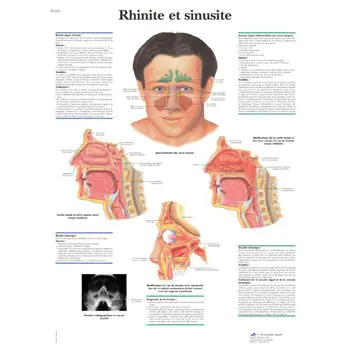 Planche anatomique Rhinite et sinusite VR2251L