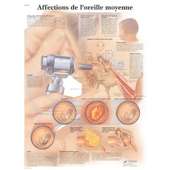 Planche anatomique Affections de l'oreille moyenne VR2252UU