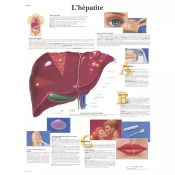Planche anatomique L'hépatite VR2435L