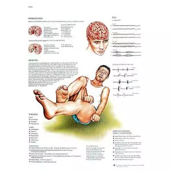 Planche anatomique Epilepsie VR2626L