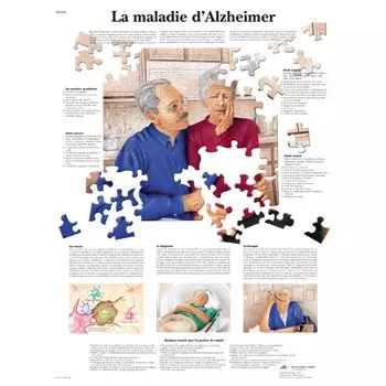 Planche anatomique La maladie d'Alzheimer VR2628UU