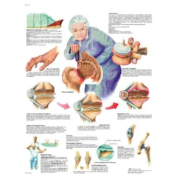 Planche anatomique l'Arthrose VR2123L