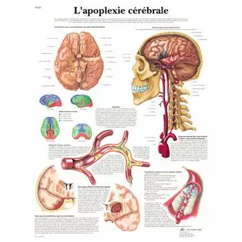 Planche anatomique Apoplexie cérébrale VR2627L