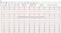 ECG numérique Spengler Cardiomate PC-ECG (12 pistes)