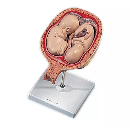 Fœtus jumeaux à 5 mois, position normale L10/7