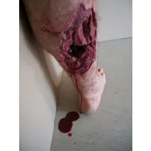 Modèle de jambe avec blessure de guerre Erler Zimmer R50010