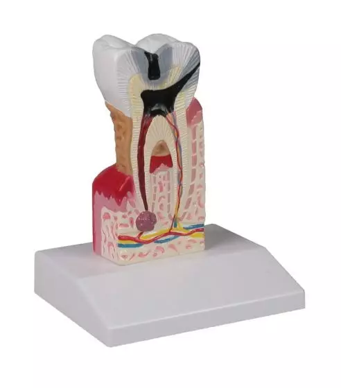 Modèle de molaire avec caries grossie 10 fois - D214 Erler Zimmer