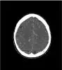 Fantôme tête et cou pour tomodensitométrie radiographie et radiothérapie Erler Zimmer